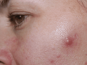 cyctic acne