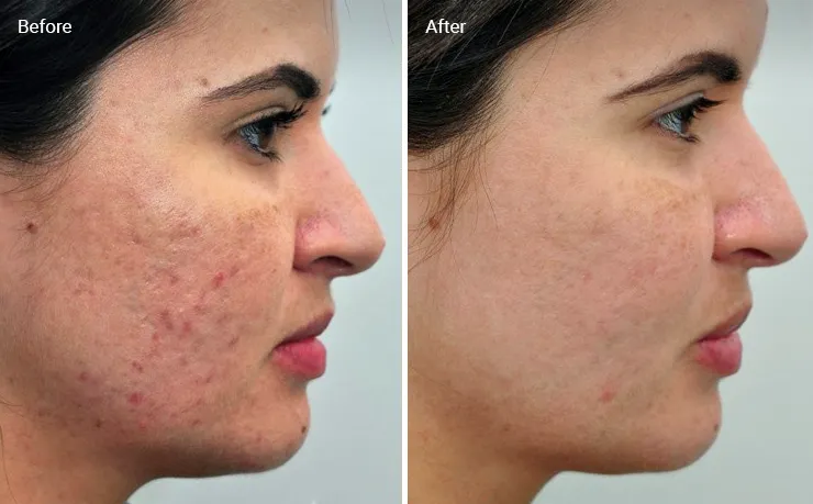 laser treatment acne ব্রণের দাগ 