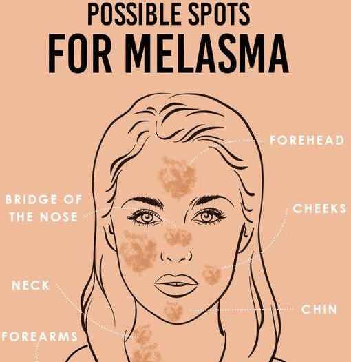 Melasma
