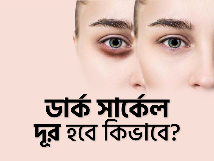 ডার্ক সার্কেল দূর হবে কিভাবে?